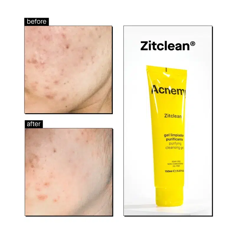 Очищающий гель для проблемной кожи Acnemy ZITCLEAN, 150 мл