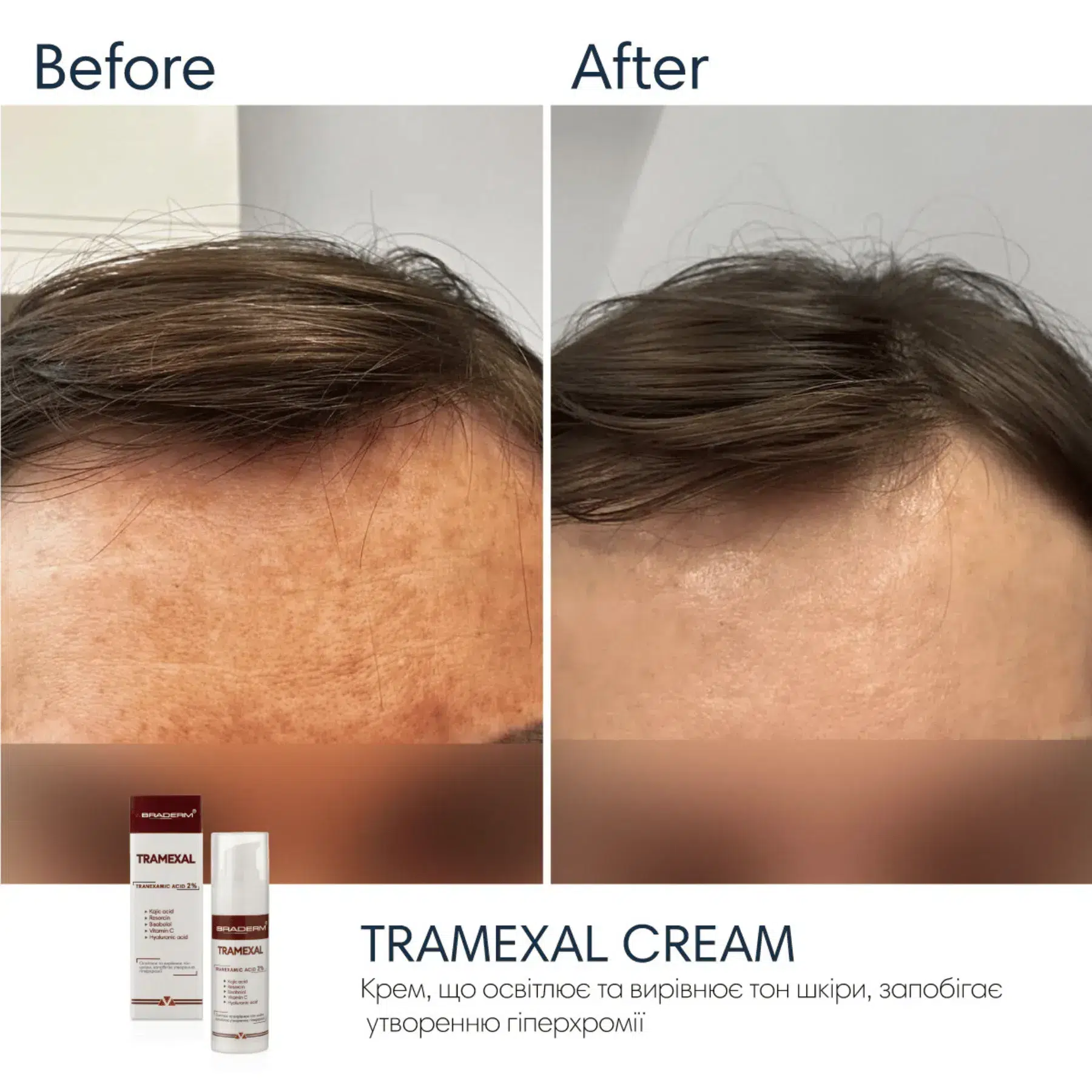 Освітлююча емульсія проти пігментації Braderm Tramexal Cream, 30 мл