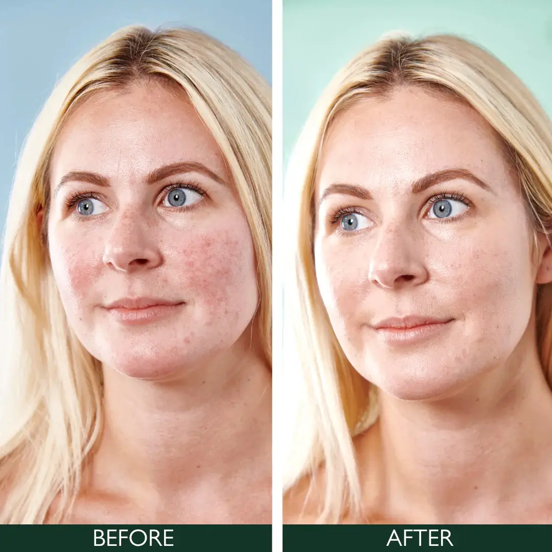 Денний крем проти почервонінь 5 в 1 Sorted Skin 5 in 1 Anti-Redness Day Cream, 30 мл