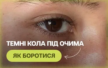 Як боротися з темними колами під очима