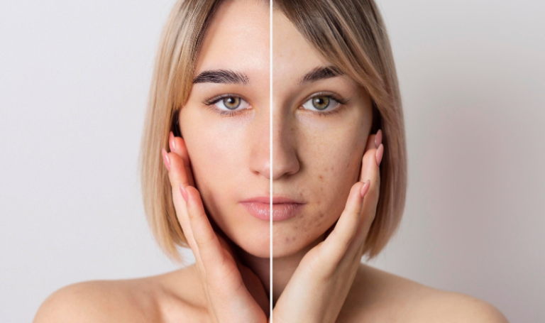 Догляд за проблемною шкірою: головні правила та приклади щоденної рутини від Beauty Systema