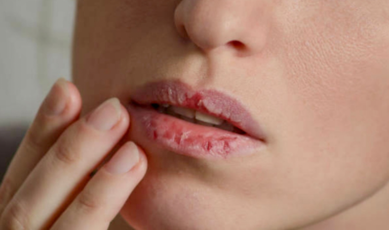 Що робити, якщо дуже сухі губи: причини, догляд та ефективні засоби