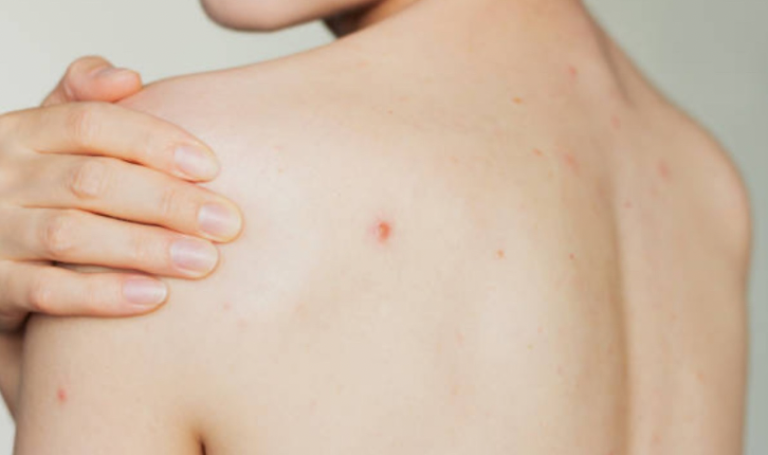 Прищі на спині та в зоні декольте: чому з’являються та як від них позбутися