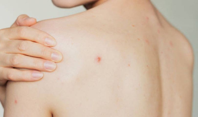 Прищі на спині та в зоні декольте: чому з’являються та як від них позбутися