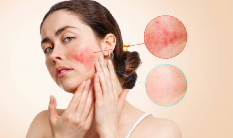 В мене розацеа? Як розпізнати, заспокоїти й доглядати шкіру