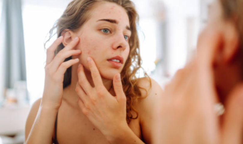 Чому прищі з’являються в одному й тому самому місці?