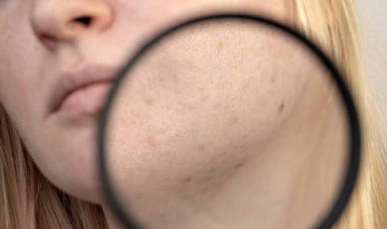 Як зменшити прояви постакне?